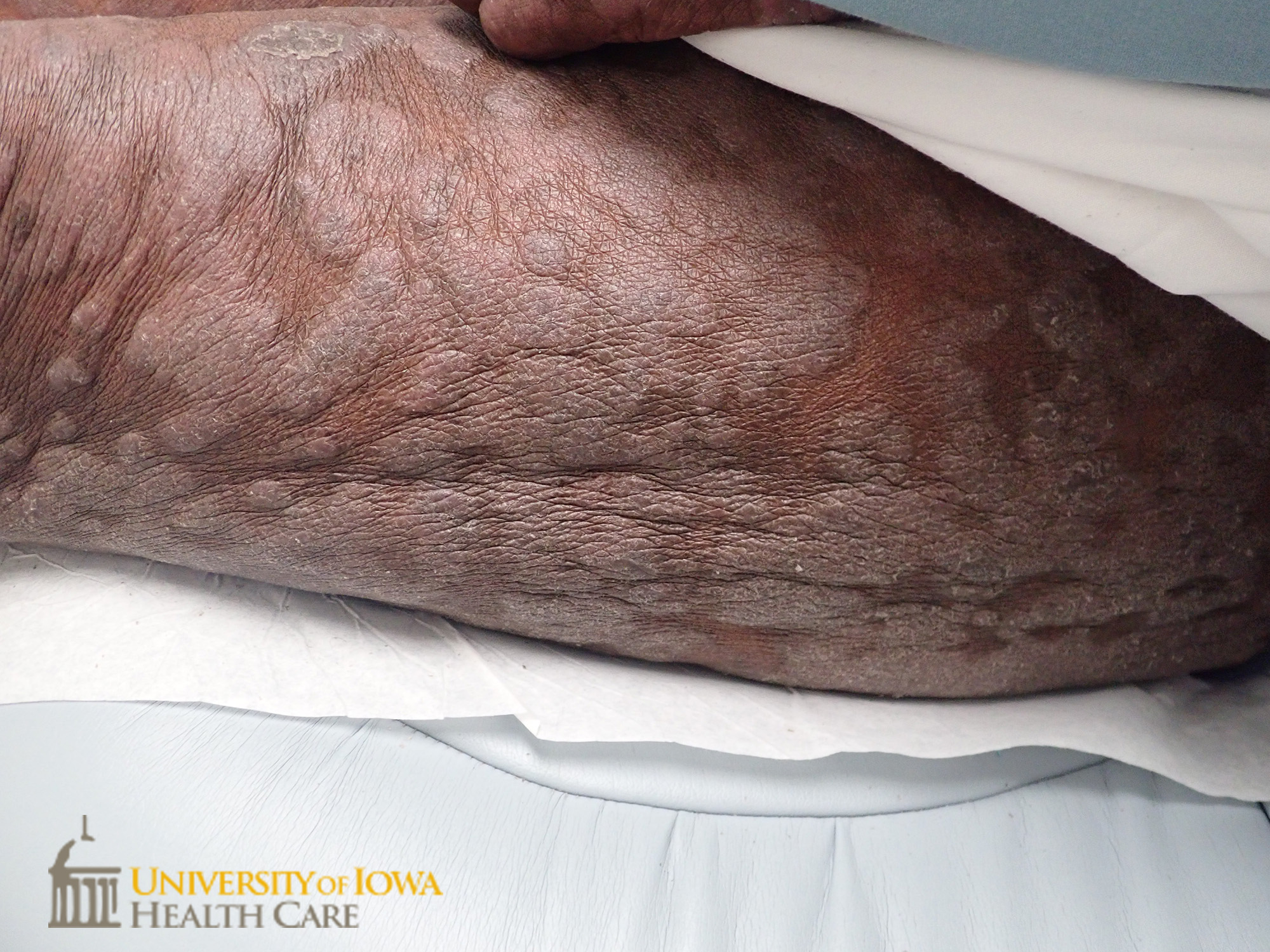 Pink to gray thick scaly plaques on the lower extremity. (click images for higher resolution).